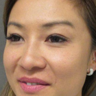 Compare Before & After Photos of _procedure_photos.phpDouble Eyelid Creation