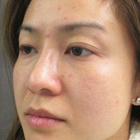 Compare Before & After Photos of _procedure_photos.phpDouble Eyelid Creation