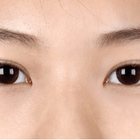 Compare Before & After Photos of _procedure_photos.phpDouble Eyelid Creation