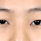 Compare Before & After Photos of _procedure_photos.phpDouble Eyelid Creation