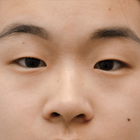 Compare Before & After Photos of _procedure_photos.phpDouble Eyelid Creation