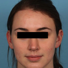 Compare Before & After Photos of _procedure_photos.phpHairline Lowering Surgery