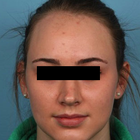 Compare Before & After Photos of _procedure_photos.phpHairline Lowering Surgery