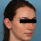 Compare Before & After Photos of _procedure_photos.phpHairline Lowering Surgery