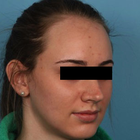 Compare Before & After Photos of _procedure_photos.phpHairline Lowering Surgery