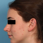 Compare Before & After Photos of _procedure_photos.phpHairline Lowering Surgery