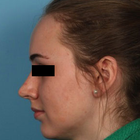 Compare Before & After Photos of _procedure_photos.phpHairline Lowering Surgery