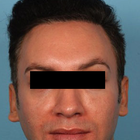 Compare Before & After Photos of _procedure_photos.phpHairline Lowering Surgery