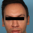 Compare Before & After Photos of _procedure_photos.phpHairline Lowering Surgery