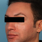 Compare Before & After Photos of _procedure_photos.phpHairline Lowering Surgery