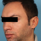 Compare Before & After Photos of _procedure_photos.phpHairline Lowering Surgery