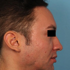 Compare Before & After Photos of _procedure_photos.phpHairline Lowering Surgery