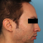 Compare Before & After Photos of _procedure_photos.phpHairline Lowering Surgery