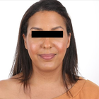 Compare Before & After Photos of _procedure_photos.phpHairline Lowering Surgery