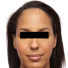 Compare Before & After Photos of _procedure_photos.phpHairline Lowering Surgery