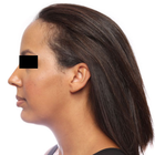 Compare Before & After Photos of _procedure_photos.phpHairline Lowering Surgery