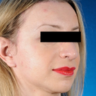Compare Before & After Photos of _procedure_photos.phpHairline Lowering Surgery