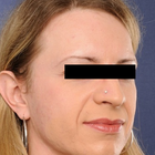 Compare Before & After Photos of _procedure_photos.phpHairline Lowering Surgery