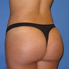 Compare Before & After Photos of _procedure_photos.phpBrazilian Butt Lift