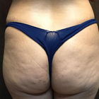 Compare Before & After Photos of _procedure_photos.phpBrazilian Butt Lift