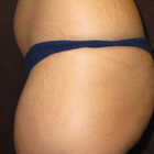 Compare Before & After Photos of _procedure_photos.phpBrazilian Butt Lift