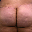 Compare Before & After Photos of _procedure_photos.phpButt Lift