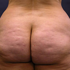 Compare Before & After Photos of _procedure_photos.phpButt Lift