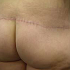 Compare Before & After Photos of _procedure_photos.phpButt Lift