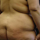 Compare Before & After Photos of _procedure_photos.phpButt Lift
