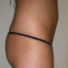 Compare Before & After Photos of _procedure_photos.phpButt Lift