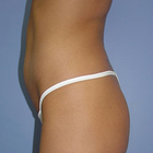 Compare Before & After Photos of _procedure_photos.phpButt Lift