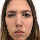 Compare Before & After Photos of _procedure_photos.phpWrinkle Treatment