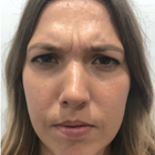 Compare Before & After Photos of _procedure_photos.phpWrinkle Treatment