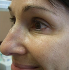 Compare Before & After Photos of _procedure_photos.phpWrinkle Treatment