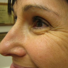 Compare Before & After Photos of _procedure_photos.phpWrinkle Treatment