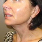 Compare Before & After Photos of _procedure_photos.phpWrinkle Treatment