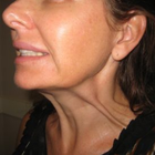 Compare Before & After Photos of _procedure_photos.phpWrinkle Treatment