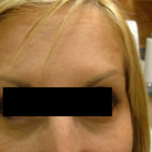 Compare Before & After Photos of _procedure_photos.phpWrinkle Treatment