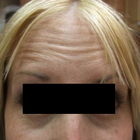 Compare Before & After Photos of _procedure_photos.phpWrinkle Treatment
