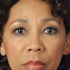 Compare Before & After Photos of _procedure_photos.phpWrinkle Treatment