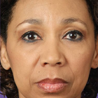 Compare Before & After Photos of _procedure_photos.phpWrinkle Treatment