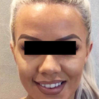 Compare Before & After Photos of _procedure_photos.phpBotox Injections