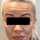 Compare Before & After Photos of _procedure_photos.phpBotox Injections