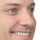 Compare Before & After Photos of _procedure_photos.phpBotox Injections