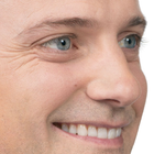 Compare Before & After Photos of _procedure_photos.phpBotox Injections