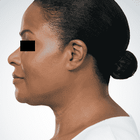 Compare Before & After Photos of _procedure_photos.phpBotox Injections