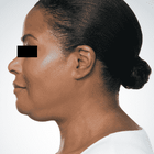 Compare Before & After Photos of _procedure_photos.phpBotox Injections