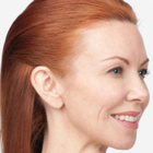 Compare Before & After Photos of _procedure_photos.phpBotox Injections