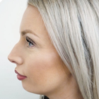 Compare Before & After Photos of _procedure_photos.phpBotox Injections