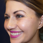 Compare Before & After Photos of _procedure_photos.phpBotox Injections